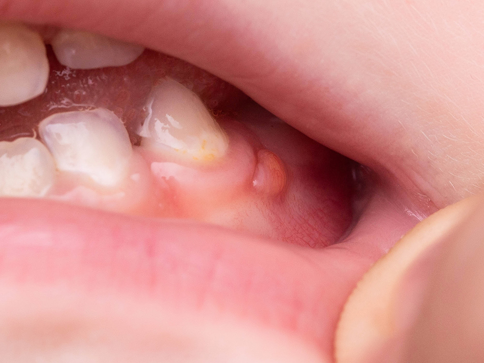 妊娠性エプーリス