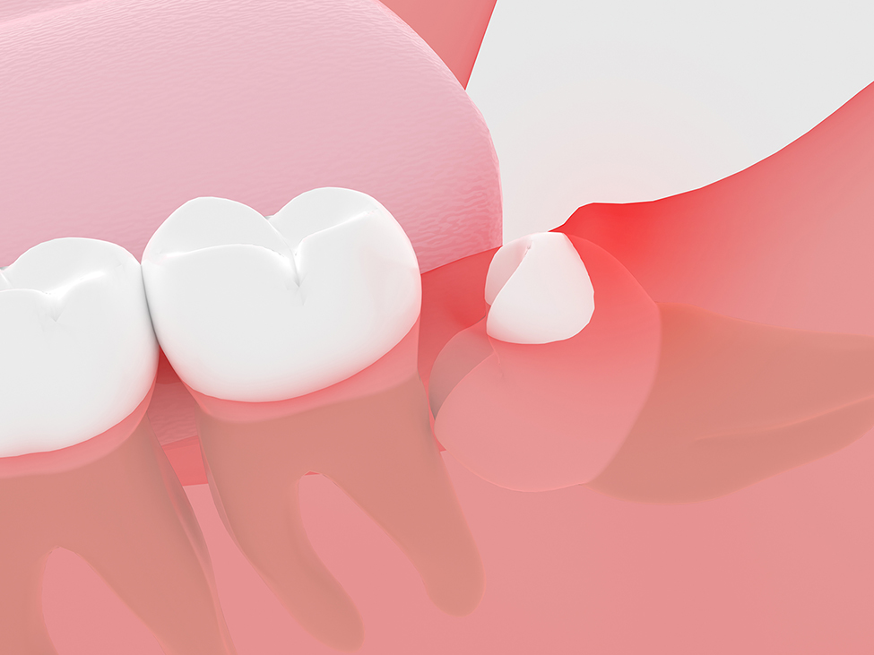 智歯周囲炎（親知らずの歯ぐきの腫れ）